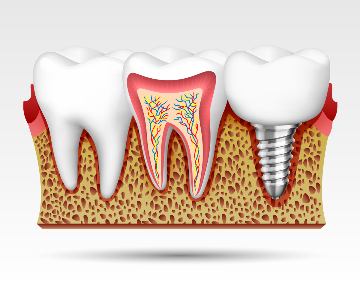 Endodontie Wurzelbehandlung